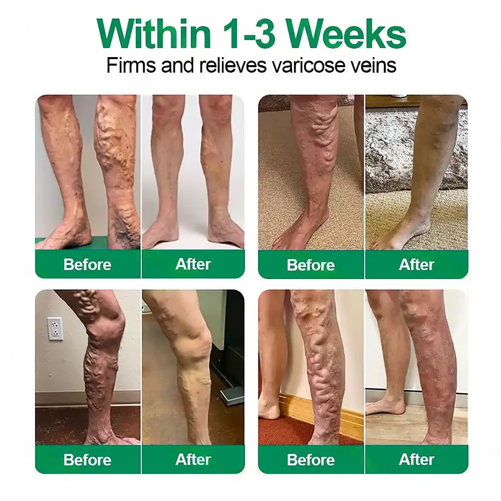๐ฆต๐ฆต๐ฆตClearenaยฎ VeinTarget Microneedle Patch โโ Once Daily, Visible Results in 7 Days - Image 11