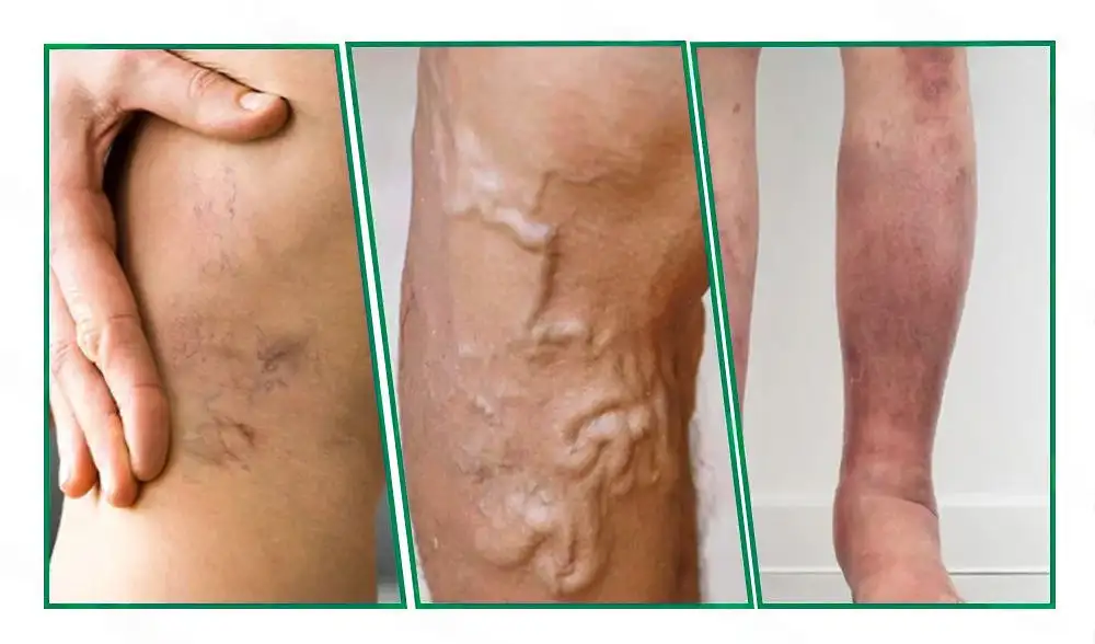 ๐ฆต๐ฆต๐ฆตClearenaยฎ VeinTarget Microneedle Patch โโ Once Daily, Visible Results in 7 Days - Image 3